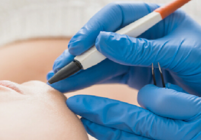 Electrolysis – Permanent Hair Removal Body Focus Spa Harare